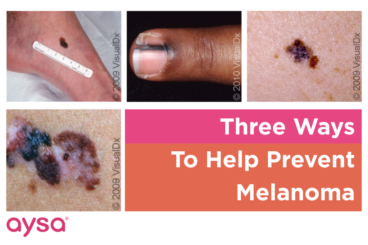 Three Ways You Can Help Prevent Melanoma » Ask Aysa