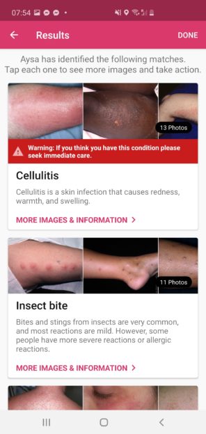 Tony's Aysa screenshot included cellulitis